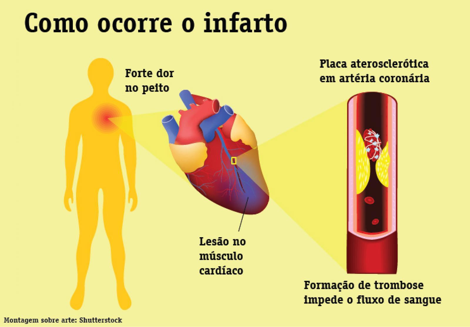 Sintomas de um Ataque Cardíaco (infarto) Os 10 Principais