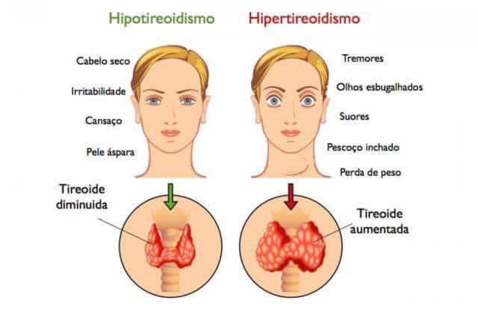 DIFERENÇA DE HIPOTIREOIDISMO E HIPERTIREOIDISMO