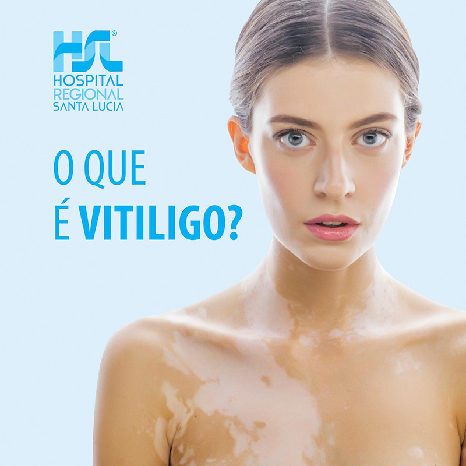 O Que é Vitiligo? | Mega Artigos