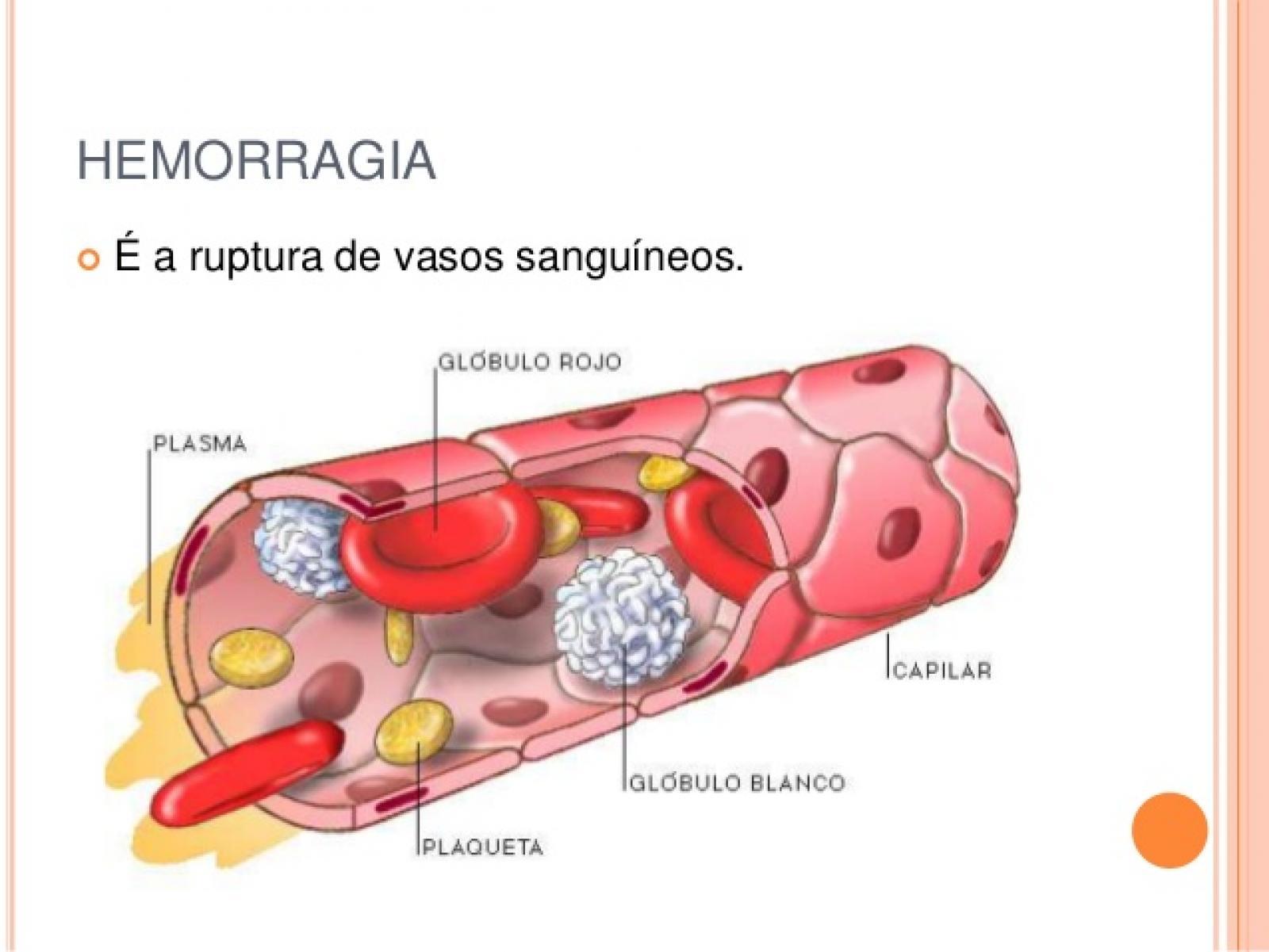 Hemorragias